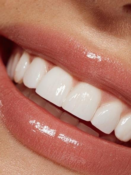 Hollywood Smile i stomatologia estetyczna, grafika poglądowa