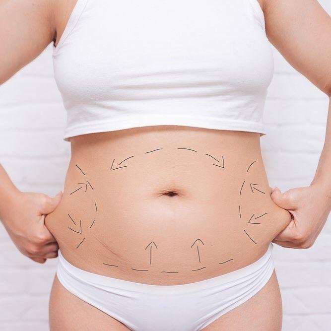 Abdominoplastyka, grafika poglądowa